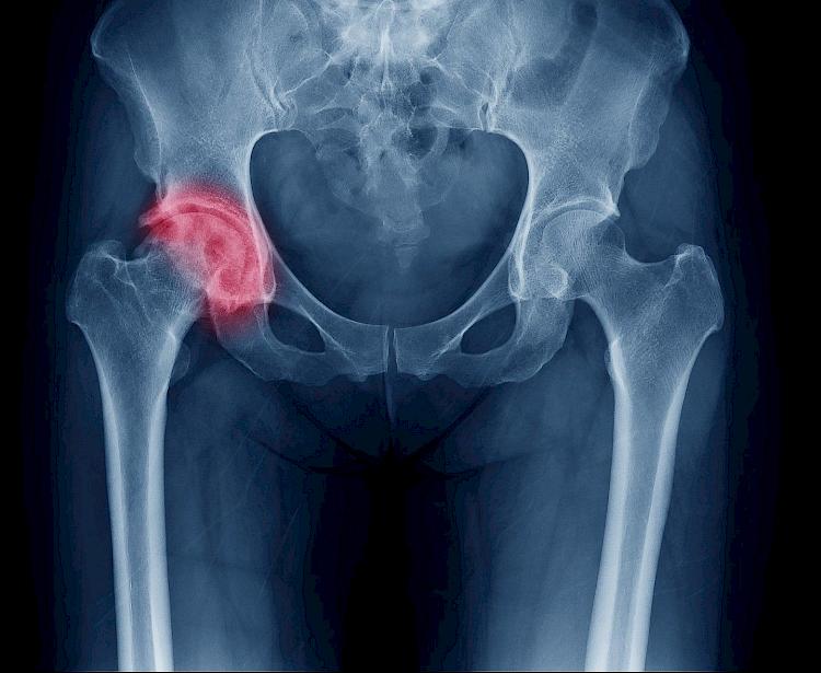 Hip Replacement Medical Negligence Claims